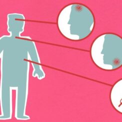 Bronşit Nedir? Bronşit Nasıl Tedavi Edilir?