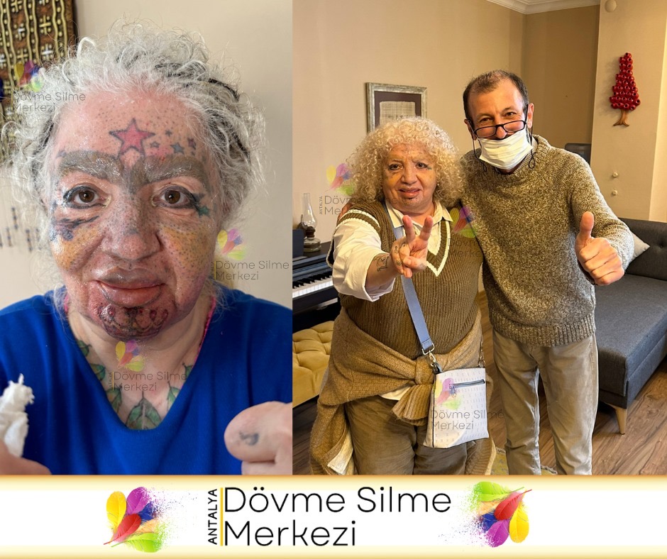 Fransa'dan Gelen Şazi Hanım'ın Antalya'da Dövme Silme Deneyimi 1 Fransa'dan Gelen Şazi Hanım'ın Antalya'da Dövme Silme Deneyimi 1