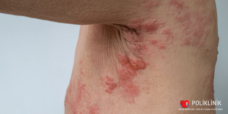 Zona Hastalığı Nedir, Belirtiler ve Tedavi Yöntemleri