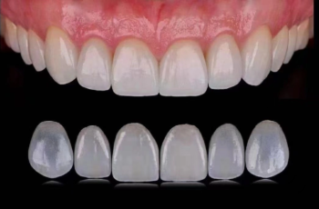 Diş Estetiğinde Yeni Trendler: Hangi Kaplama Türü Size Uygun? 1