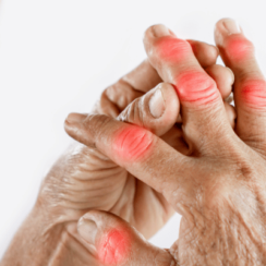 Romatizma Belirtileri Nelerdir? Hangi Bölüme Gidilmeli? 1