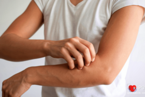 Kurdeşen Nedir Belirtileri, Neden Olur, Nasıl Geçer