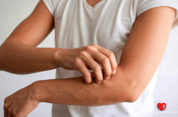 Kurdeşen Nedir Belirtileri, Neden Olur, Nasıl Geçer